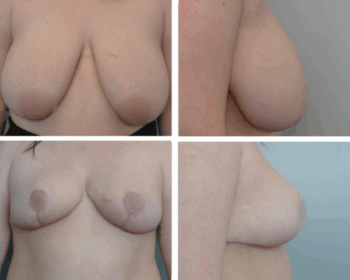 Breast Lift Portland Before and After by Dr. Tina Jenq